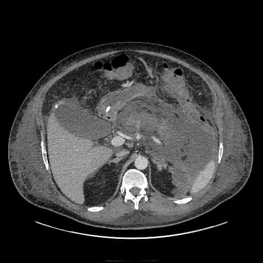 снимок компьютерной томографии поджелудочной железы